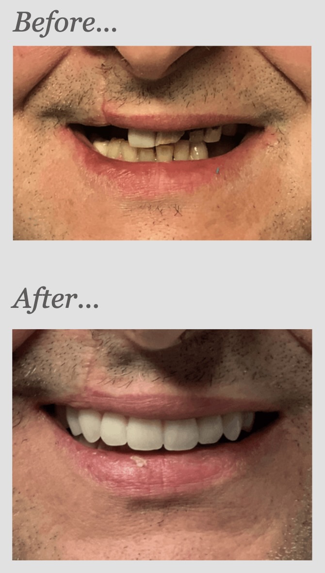 Multiple implant case, before and after: missing and damaged teeth replaced with implant-supported teeth